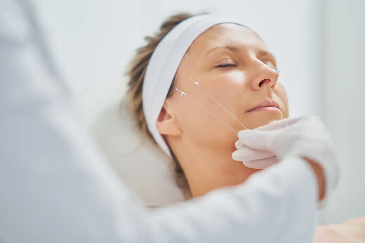 Fili di trazione viso a Milano centro - Medicina estetica antiage